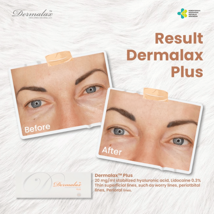 The Dermalax filler treated the patient's under-eye concerns, giving a fresher look.