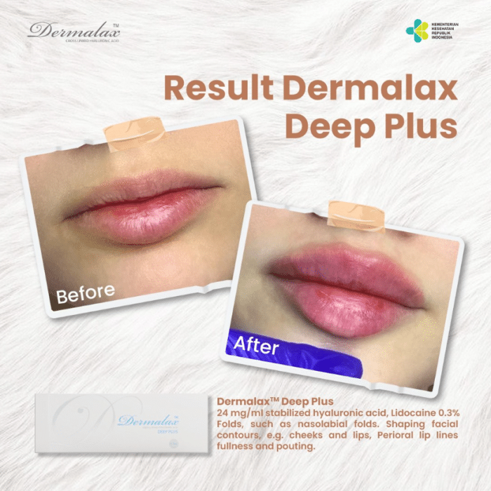 A patient undergone a Dermalax Deep Plus filler to achieve fuller lips.