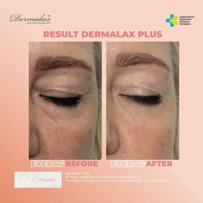 A patient's before and after photo of their Dermalax filler treatment to smoothen their under-eye.