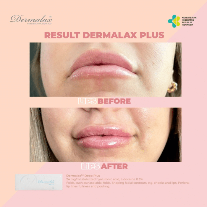 A patient achieved a more symmetrical lips using a Dermalax filler.