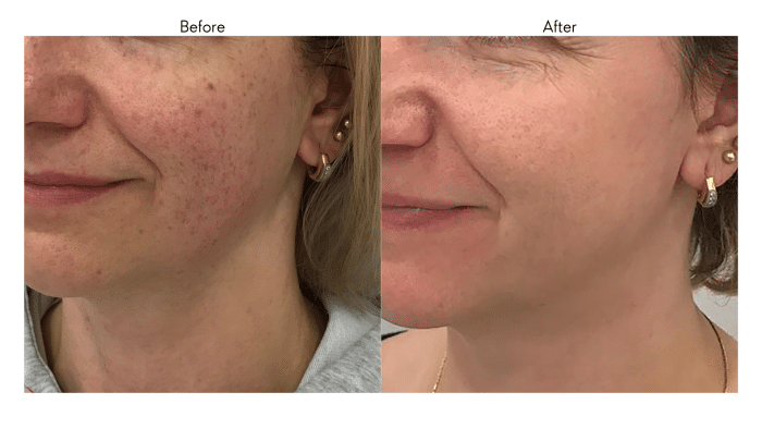 Before and after photos of an individual who underwent a Biorepeel chemical peeling treatment.