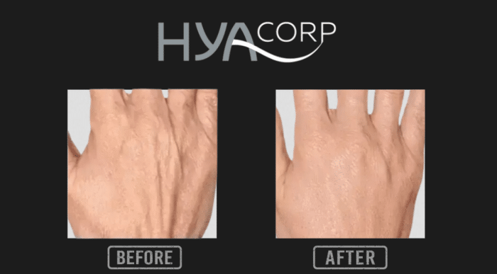 Transformative Effects of HYAcorp Fillers