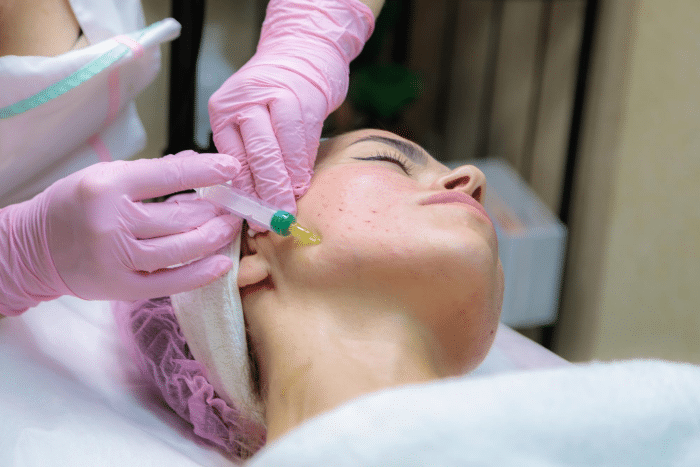 
Professional performing a hyaluron filler injection with Juvederm on a patient's face, focused on skin rejuvenation treatment.
