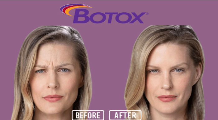 Botox Results Timeline