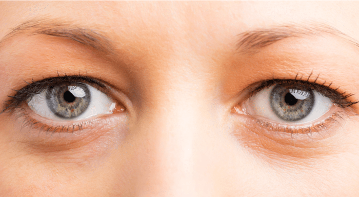 Understanding Under-Eye Concerns