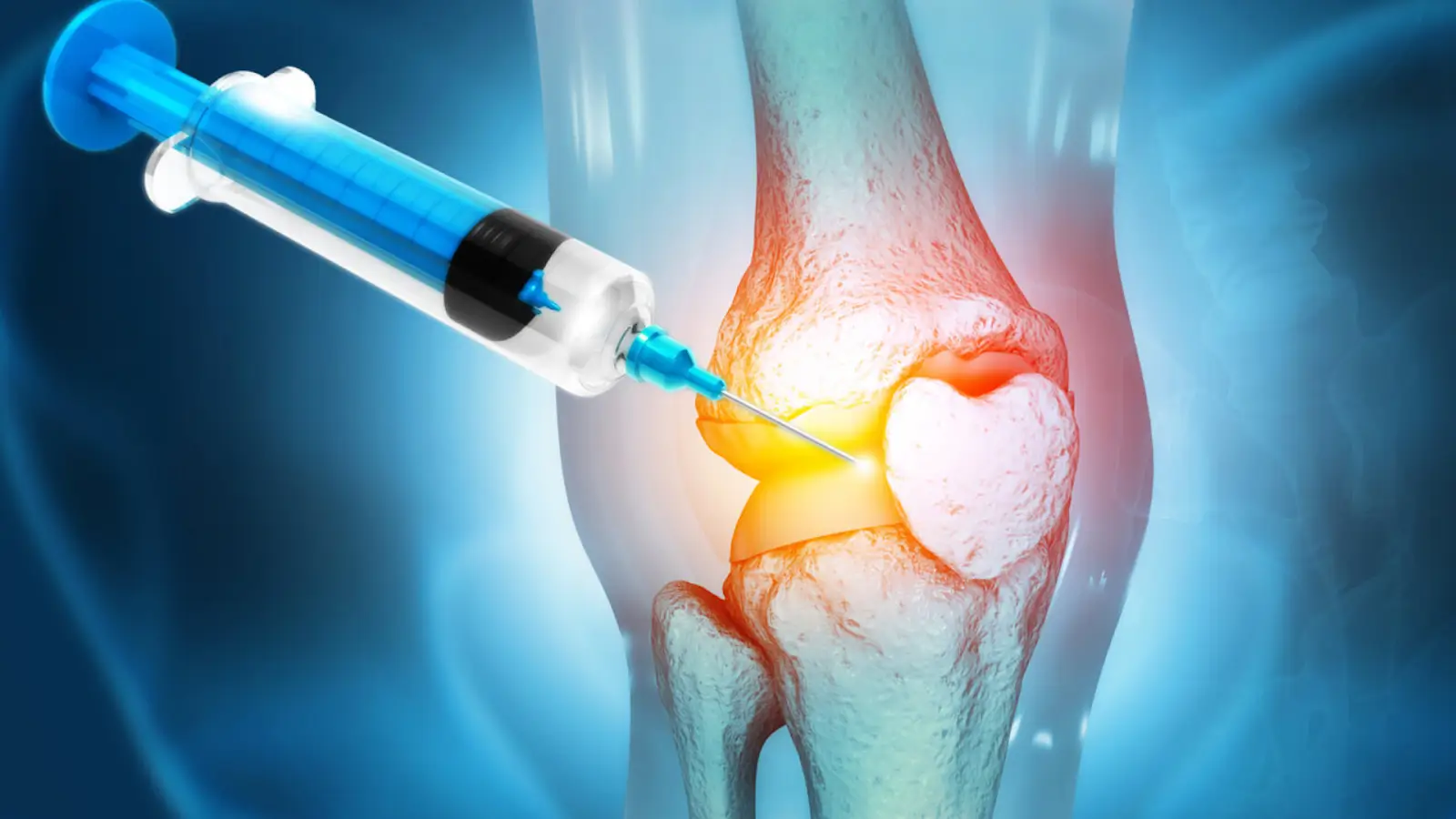 Illustration of a syringe injecting a knee joint with a highlighted area indicating where the injection is targeting.