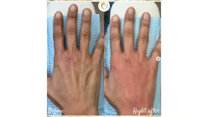 Before and after comparison of hand rejuvenation using Cytocare.