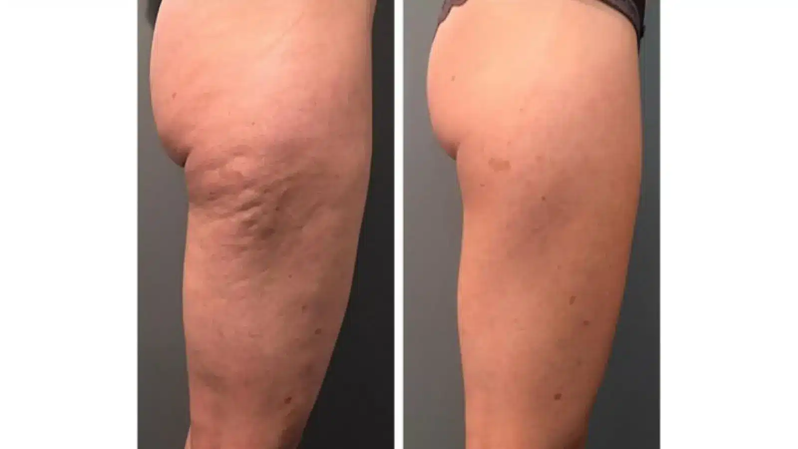 Before and after side-by-side comparison of a thigh and buttock area. The left image shows skin with visible cellulite, while the right image shows smoother skin with reduced cellulite appearance.