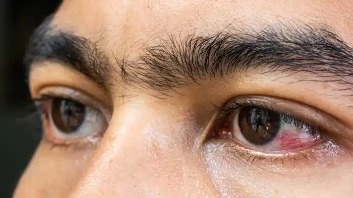 Close-up of a person's eyes showing redness and irritation. The skin around the eyes appears smooth, with prominent eyebrows. The person is looking slightly upwards, and light reflects on the surface of the eyes, indicating depth and moisture.