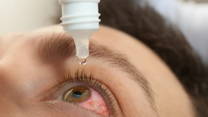 Close-up of a person with bloodshot eyes receiving an eye drop from a white bottle. The drop is about to enter the person's eye, whose skin is visible with some redness around the eye. The focus is on the eye and the drop.