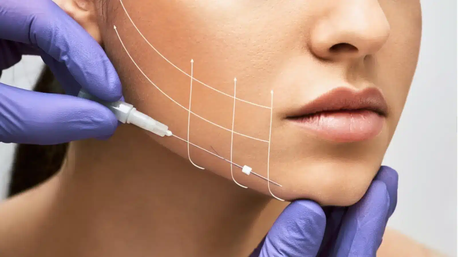 Close-up of a person receiving a cosmetic procedure on their jawline. A gloved hand holds a tool near the skin, with illustrated lines showing lifted areas. The focus is on enhancing facial contours and aesthetics.