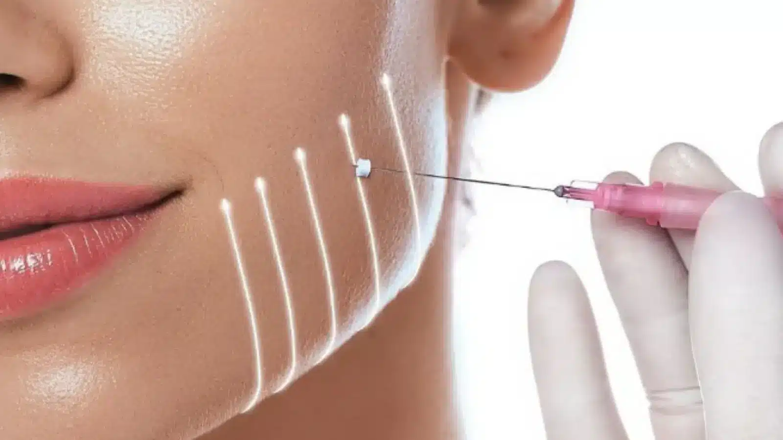 Close-up of a woman's face receiving a cosmetic treatment. 