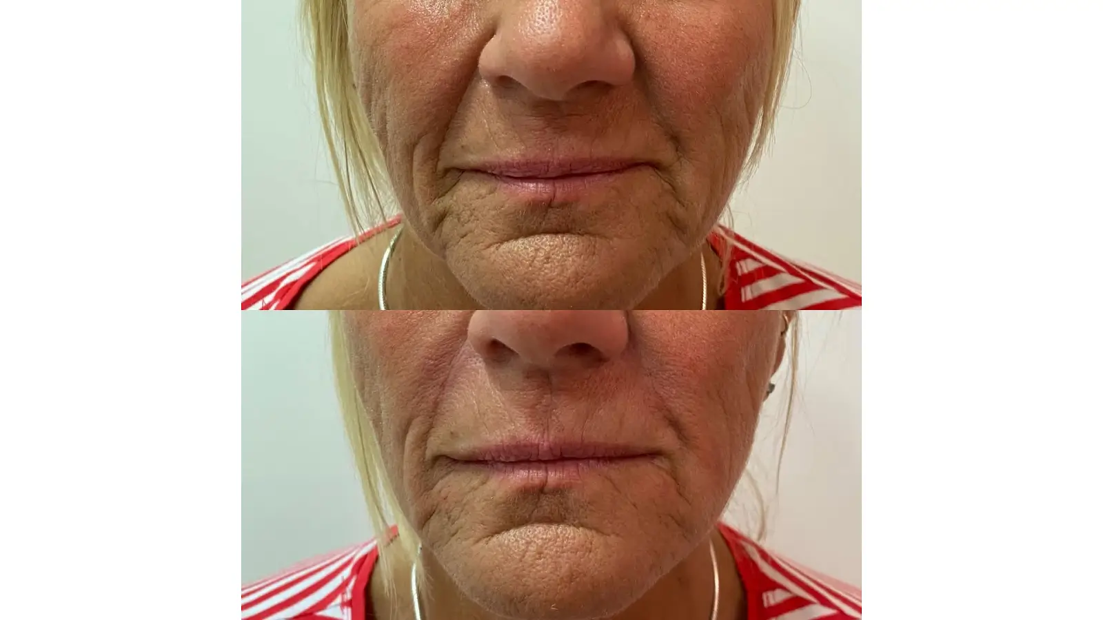 Close-up of a person's lower face showing before and after images. The top image shows more pronounced wrinkles around the lips, while the bottom image shows smoother skin with reduced wrinkles. The person is wearing a red and white striped top.