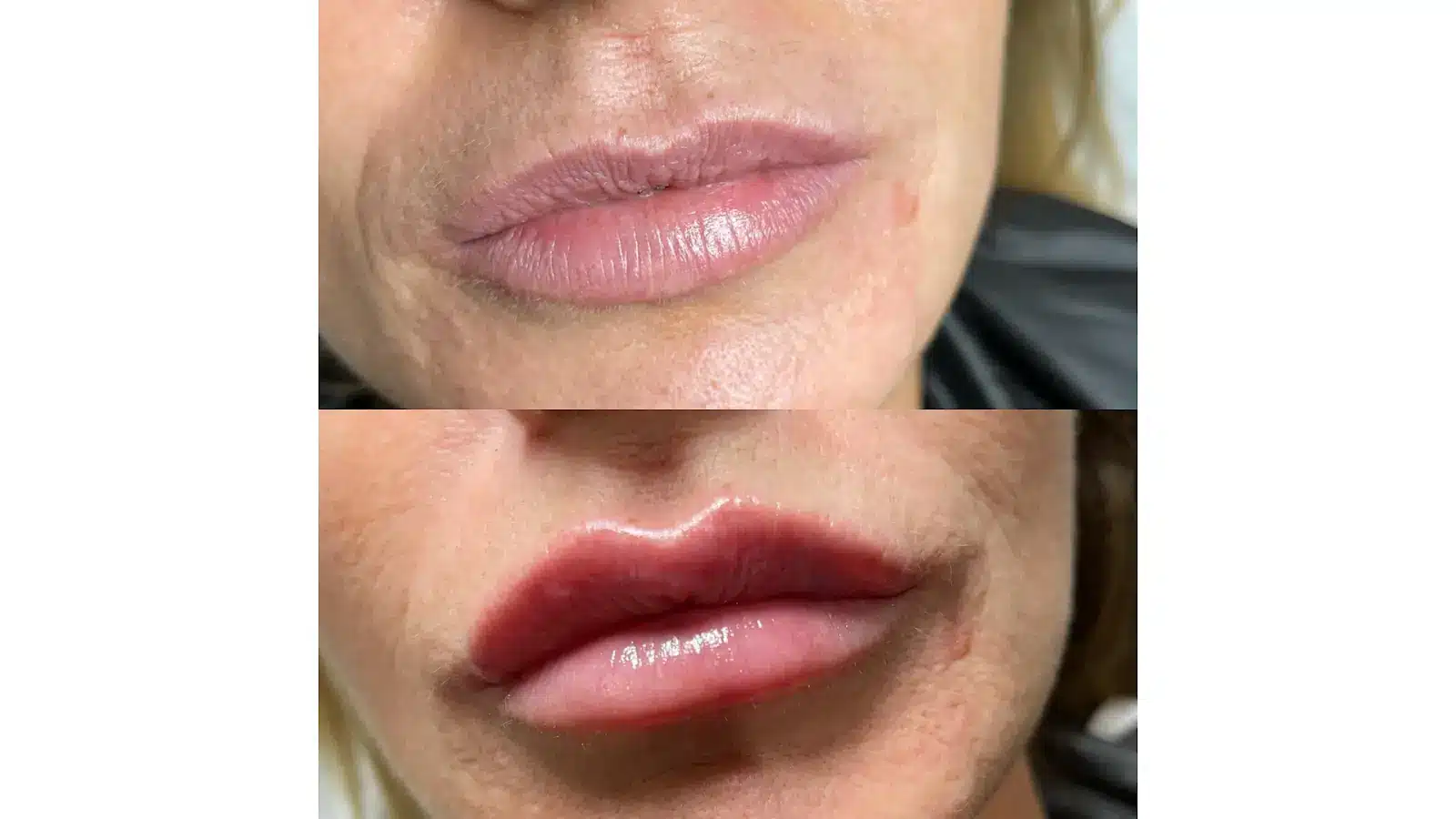 Top image shows lips with a natural appearance. Bottom image shows the same lips appearing fuller, possibly after a cosmetic procedure.