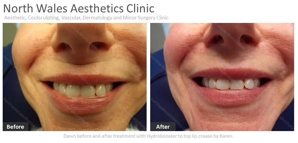 Close-up images of a person's smile, showing top lip crease changes before and after a Hydrobooster treatment. The left image labeled "Before" shows more creasing, while the right image labeled "After" shows smoother skin.