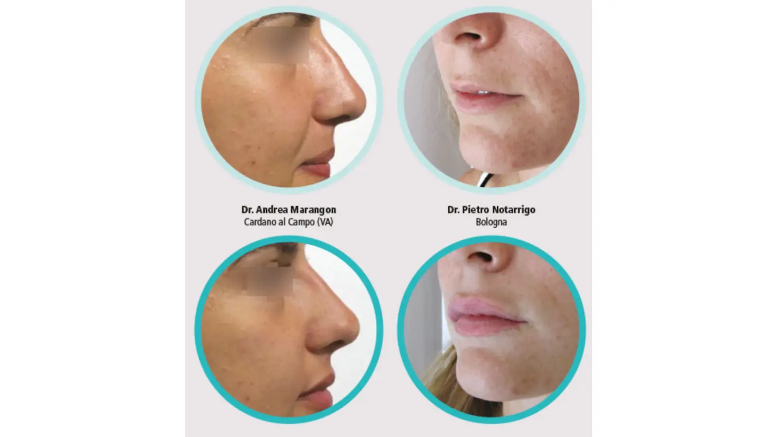Side-by-side before-and-after photos of two patients showing nose and lip enhancements. Each set of images is in a circular frame, with doctors' names and locations below: Dr. Andrea Marangon (Cairate, VA) and Dr. Pietro Notargiacomo (Bologna).