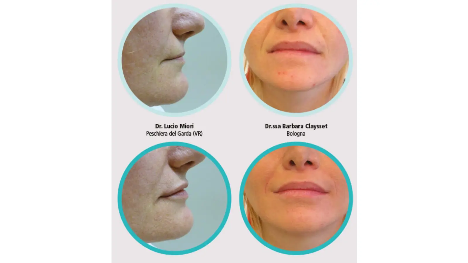 Before and after images of the lower face showing cosmetic changes. The top row displays the profiles before treatment, and the bottom row shows the results after treatment by Dr. Lucio Miori and Dr. Barbara Claysset.