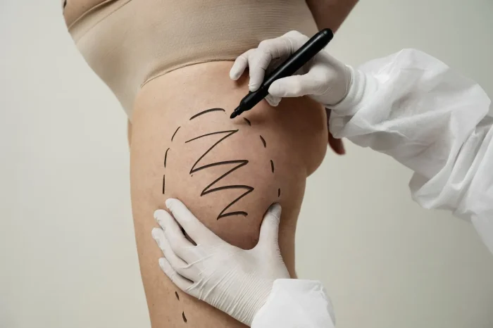A person in medical gloves draws surgical markings on another person's upper thigh and hip with a black marker, indicating a planned cosmetic procedure. The person being marked is wearing beige undergarments.