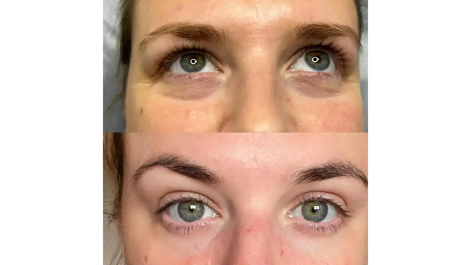 Close-up comparison of a woman's eyes and eyebrows before (top) and after (bottom) a beauty treatment, showing smoother skin, fuller eyebrows, and a more even complexion in the after image.