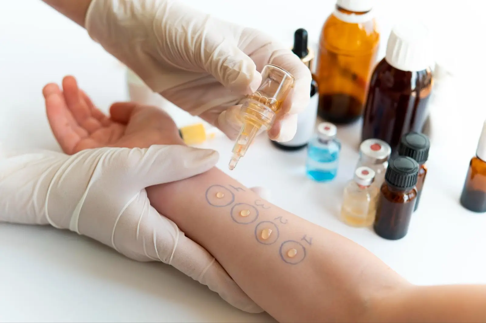 A gloved hand drips liquid onto a person's forearm marked with circles and labels, likely performing an allergy skin test. Various medicine bottles and vials are visible in the background.