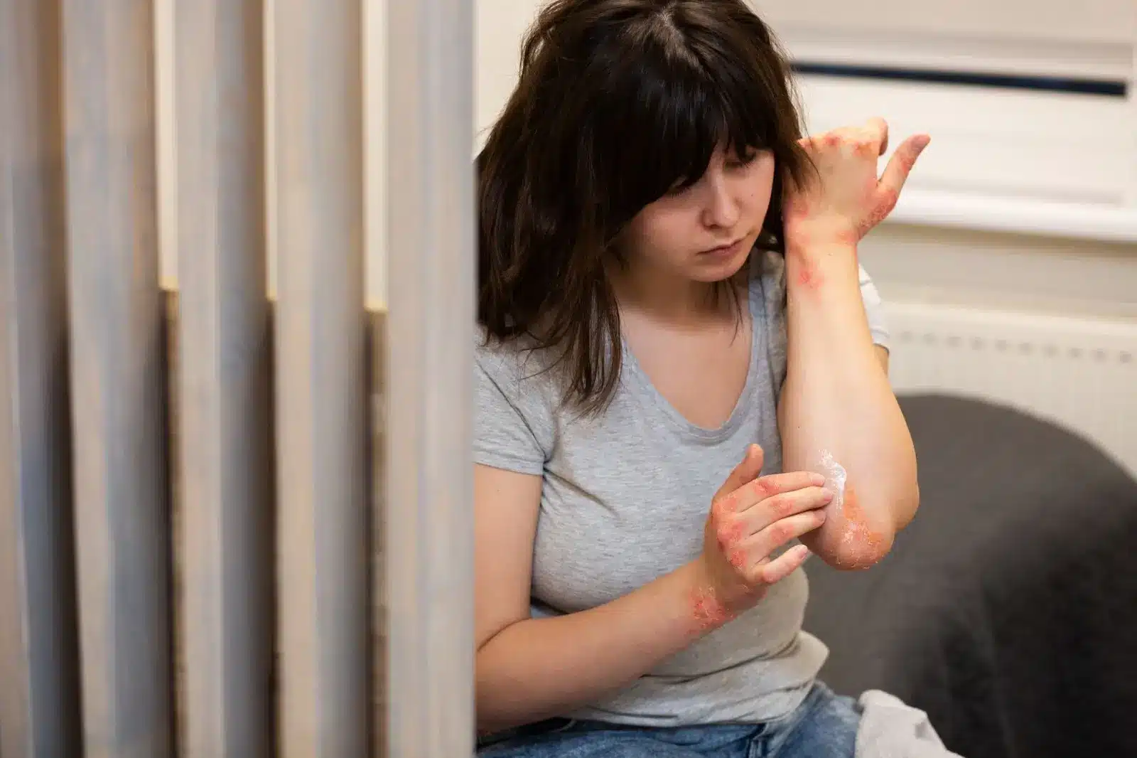 A woman with long dark hair applies cream to red, irritated patches on her forearm and hand while sitting indoors, wearing a gray t-shirt and jeans.