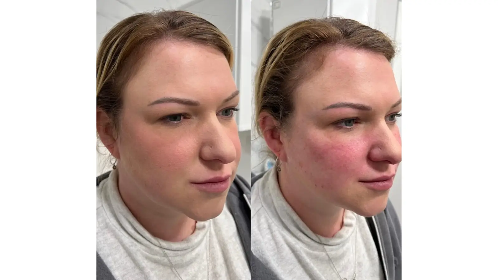 Side-by-side photos of a woman with light skin and blonde hair, showing her face before (left) and after (right) a treatment. The right image shows more facial redness and slightly shinier skin.