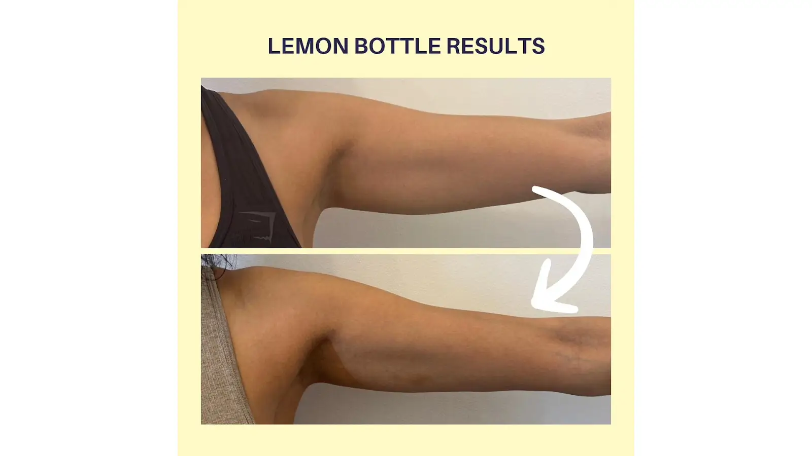 Two side-by-side photos show an arm before and after a treatment labeled "Lemon Bottle Results." The top image shows the arm before, and the bottom shows it slimmer, with a white arrow pointing down.