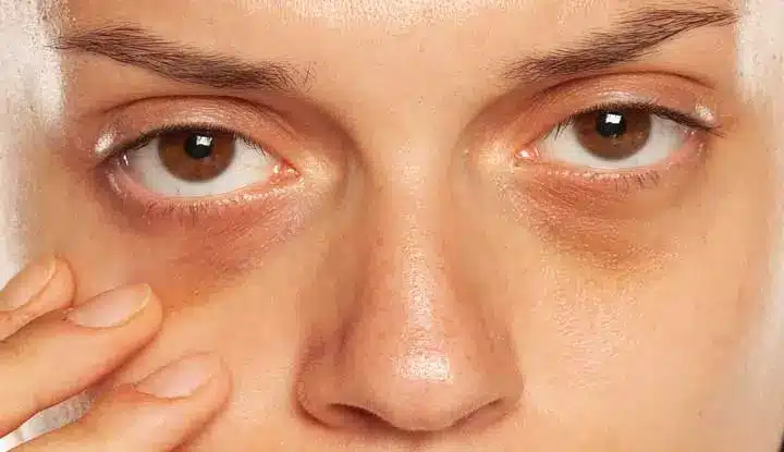A close-up of a person's face showing dark circles under their eyes, with one hand gently touching the skin below the right eye. The facial expression appears neutral.
