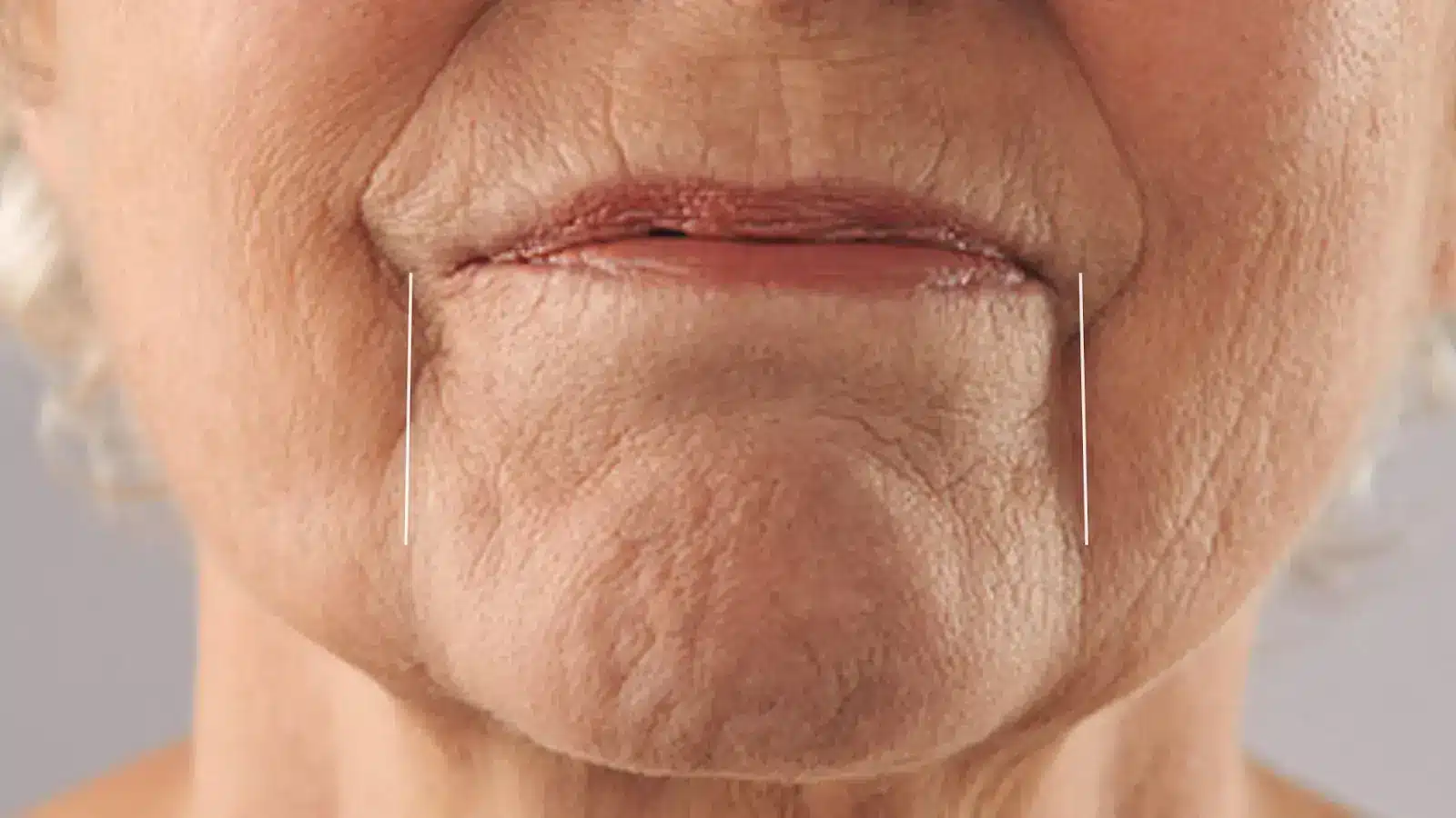 Close-up of an older person's lower face with two acupuncture needles inserted vertically into the skin near the corners of the mouth, highlighting a treatment for facial wrinkles.