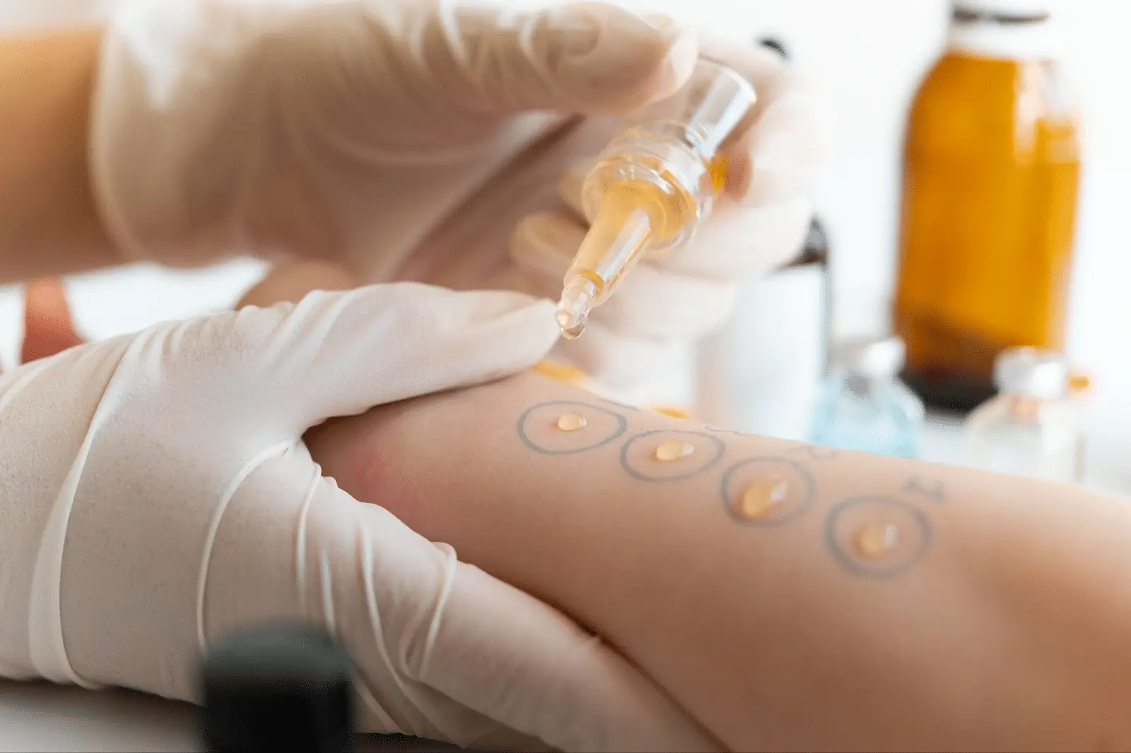 A gloved hand applies drops of liquid onto marked circles on a person’s forearm, likely administering an allergy skin test. Brown and clear bottles are blurred in the background.