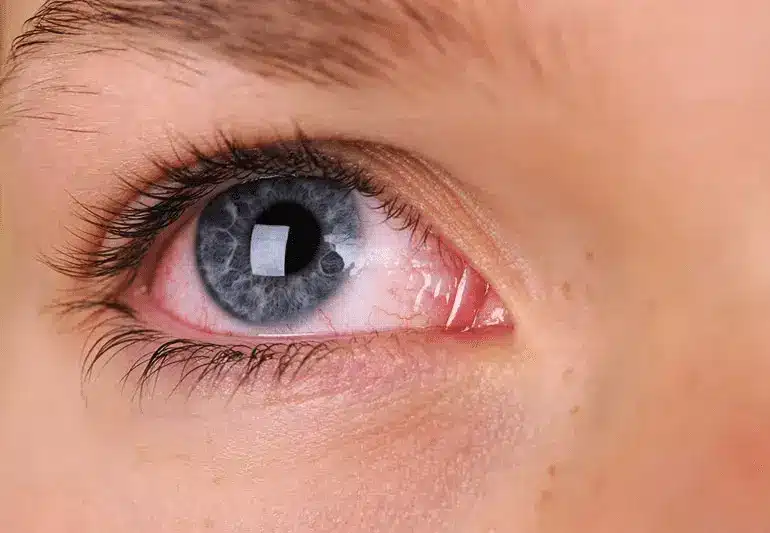 Close-up of a human eye with a blue iris, long eyelashes, and slightly red inner corner, showing detailed skin texture around the eye.