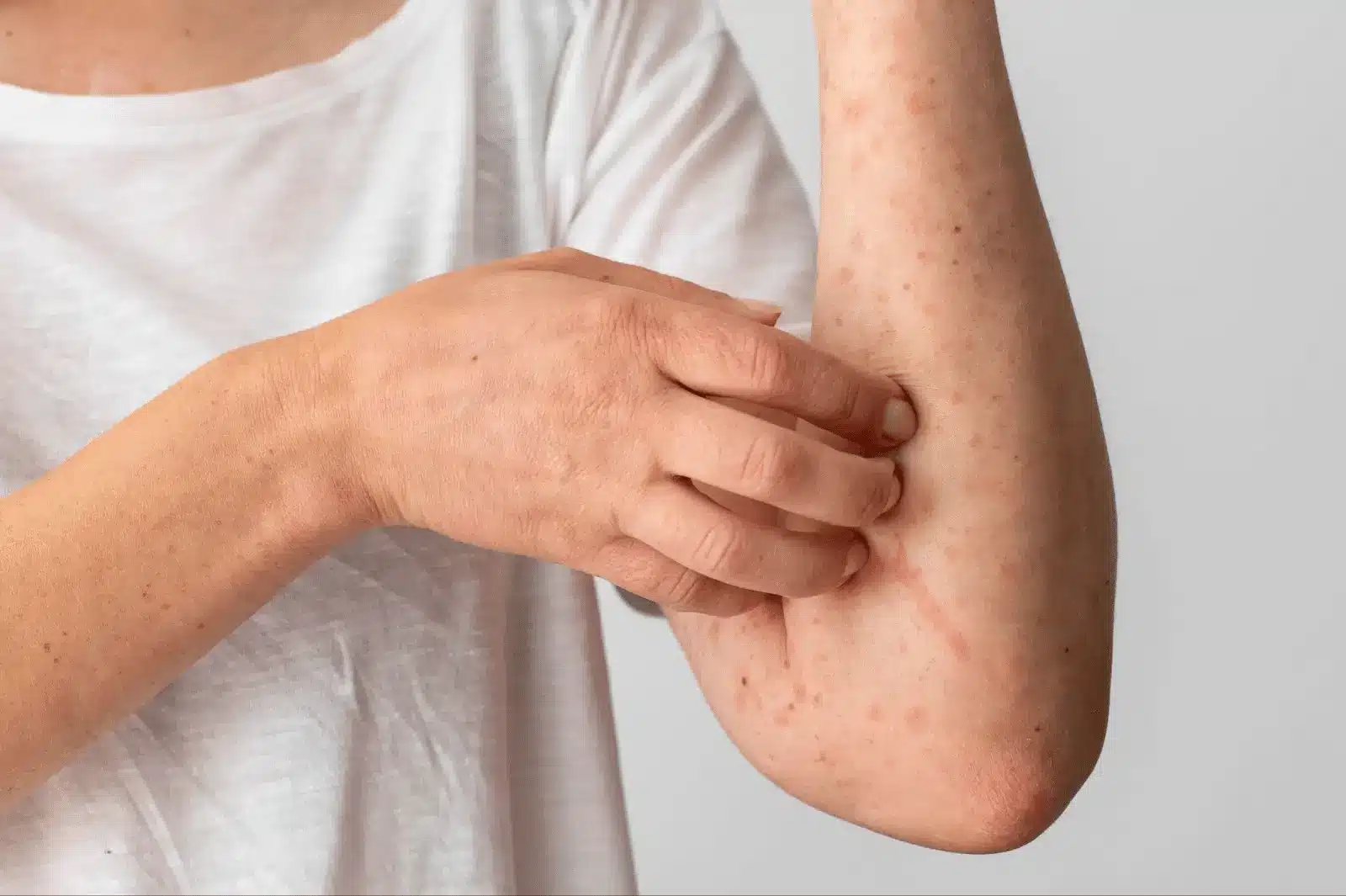 A person wearing a white shirt scratches their forearm, which appears to have red, irritated spots or a rash from Xolair treatment.