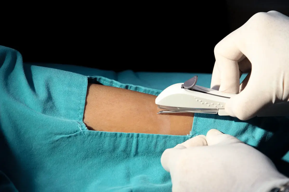 A gloved medical professional uses a surgical stapler on a patient's skin, which is exposed through a hole in a teal surgical drape. The background is dark, highlighting the procedure.
