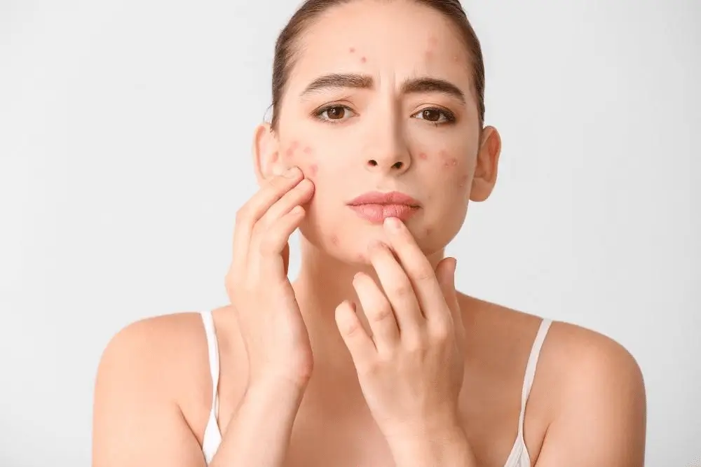 A woman with a concerned expression examines her acne-prone skin in the mirror, touching her face with both hands. She has reddish blemishes and pimples on her cheeks and forehead.