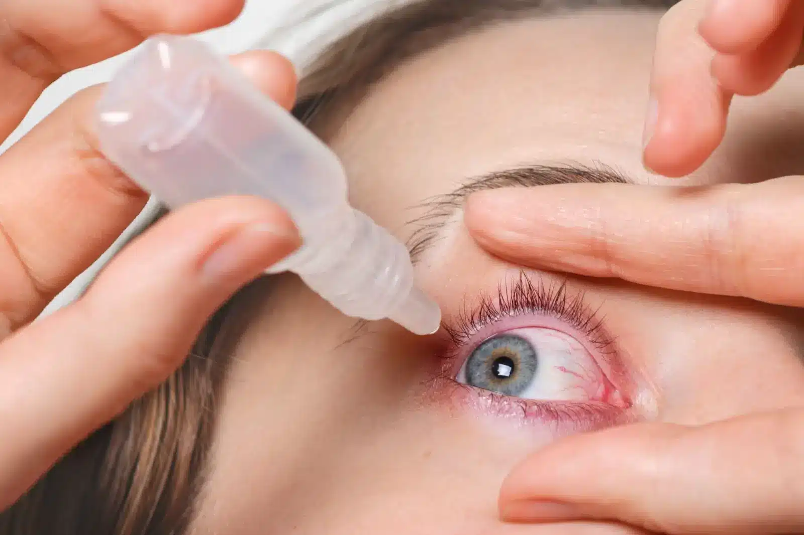 A close-up of a person using eye drops. One hand holds the bottle above an open eye, while the other pulls down the lower eyelid. The eye appears red and irritated.